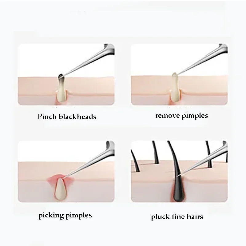 Skin Perfecting Blackhead Removal Set